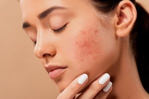 Bodybuilders Should Buy Ultima-Accutane Online For Skin Care